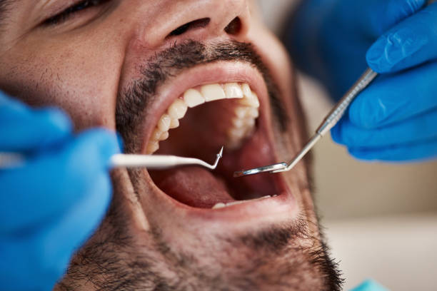 Best Emergency Tooth Extraction in Marietta, OH